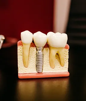 Dental implant model from Clifton Advanced Dentistry's implant offer