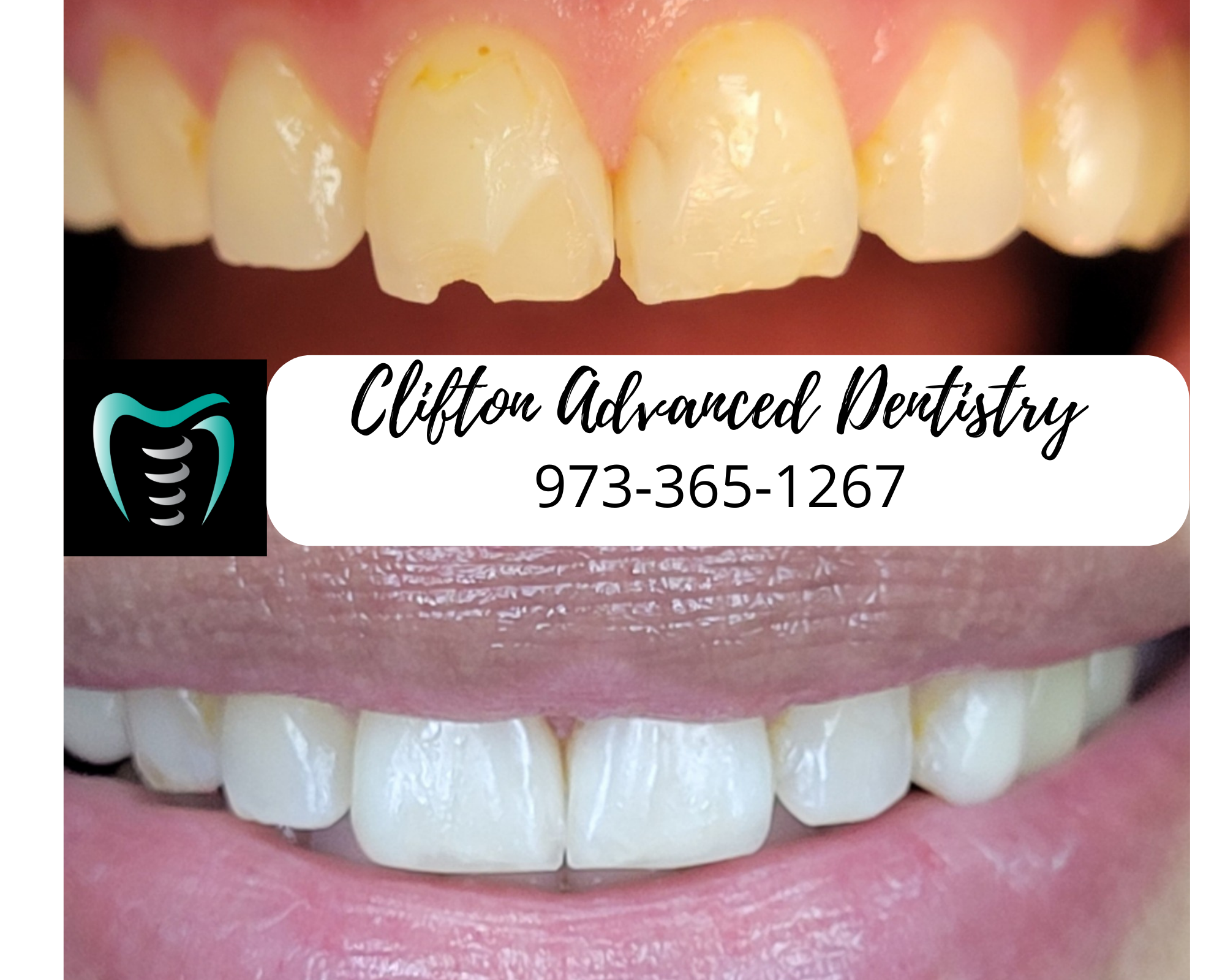 Before and after resin veneers treatment