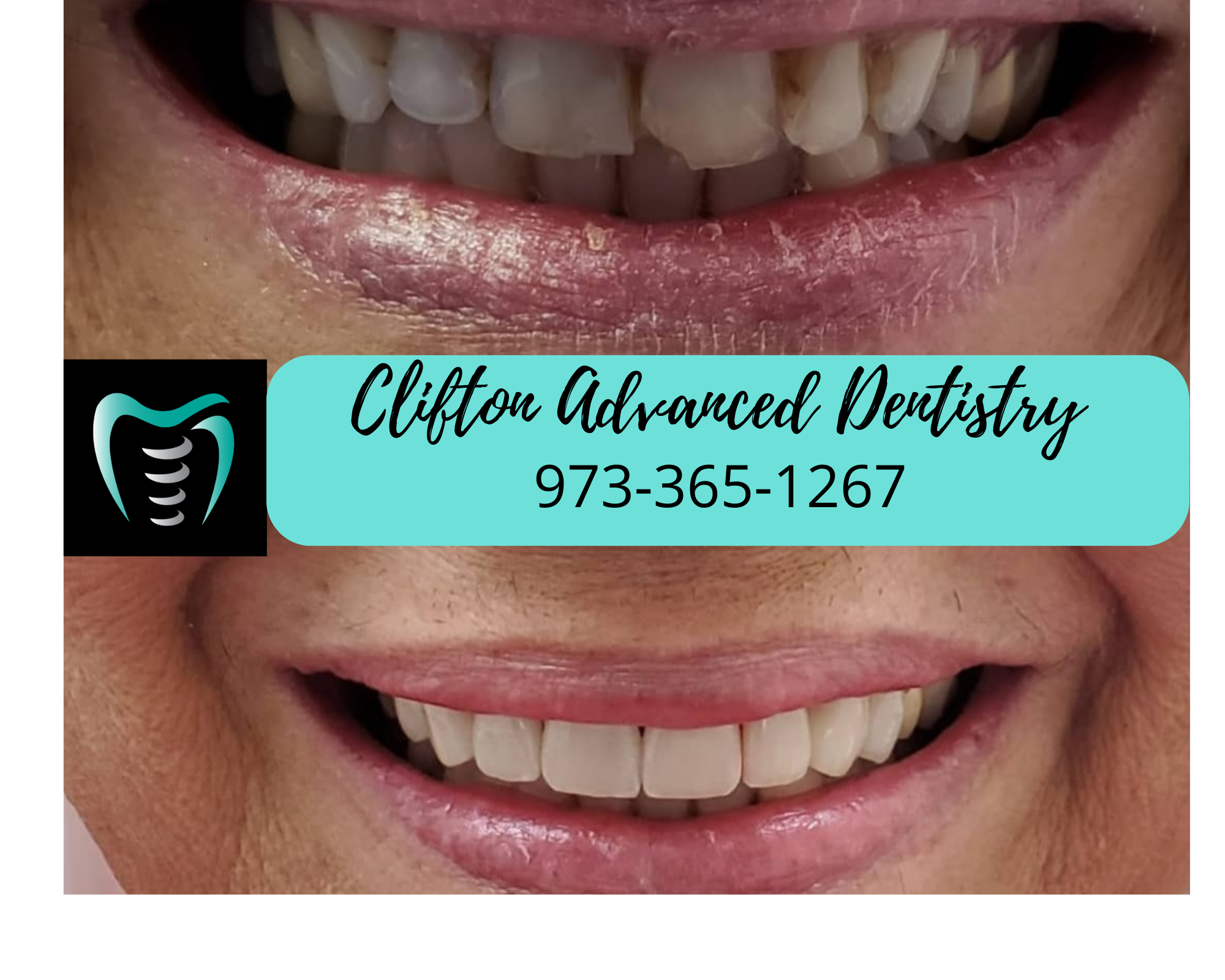 Before and after veneers treatment