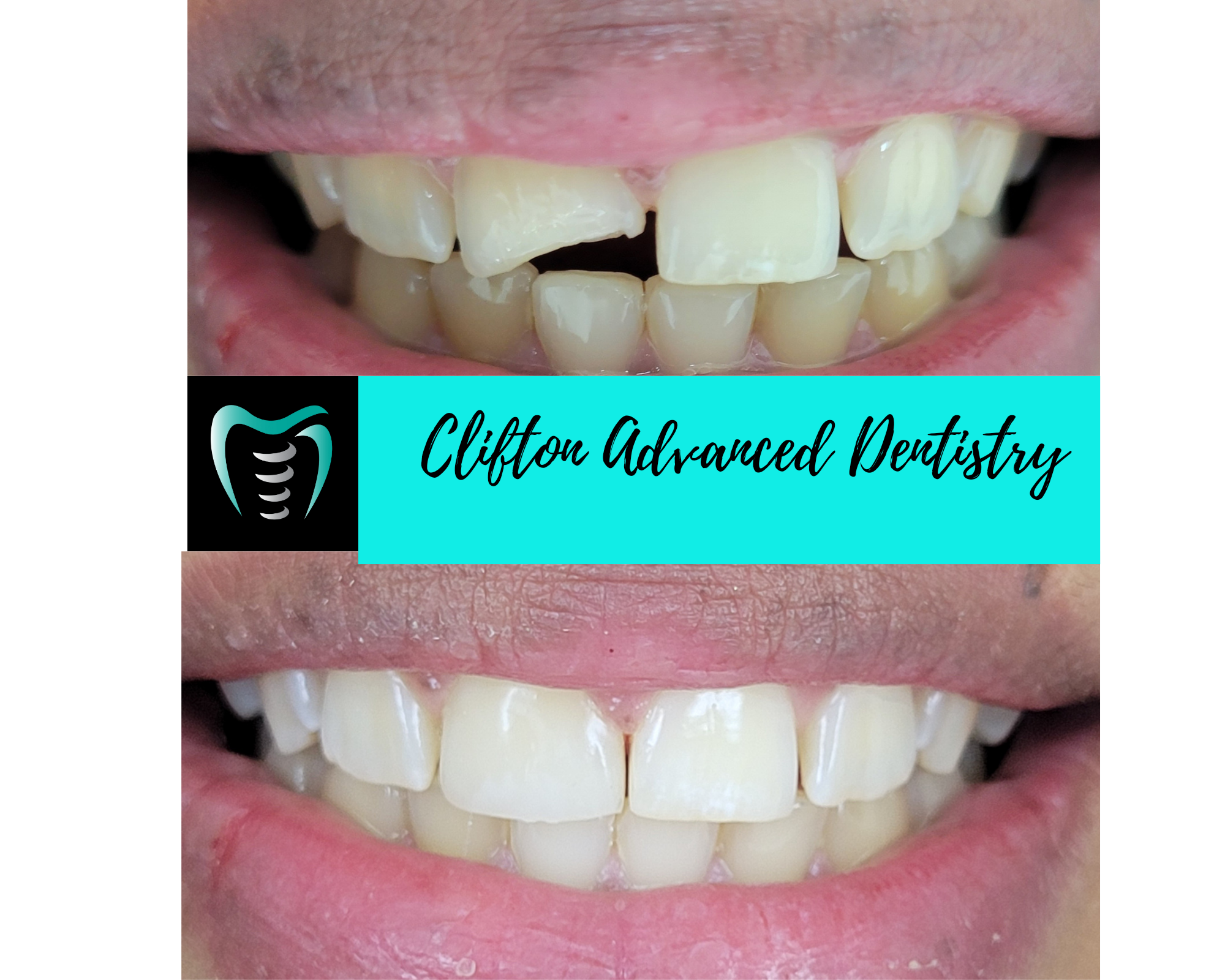 Before and after composite dental treatment