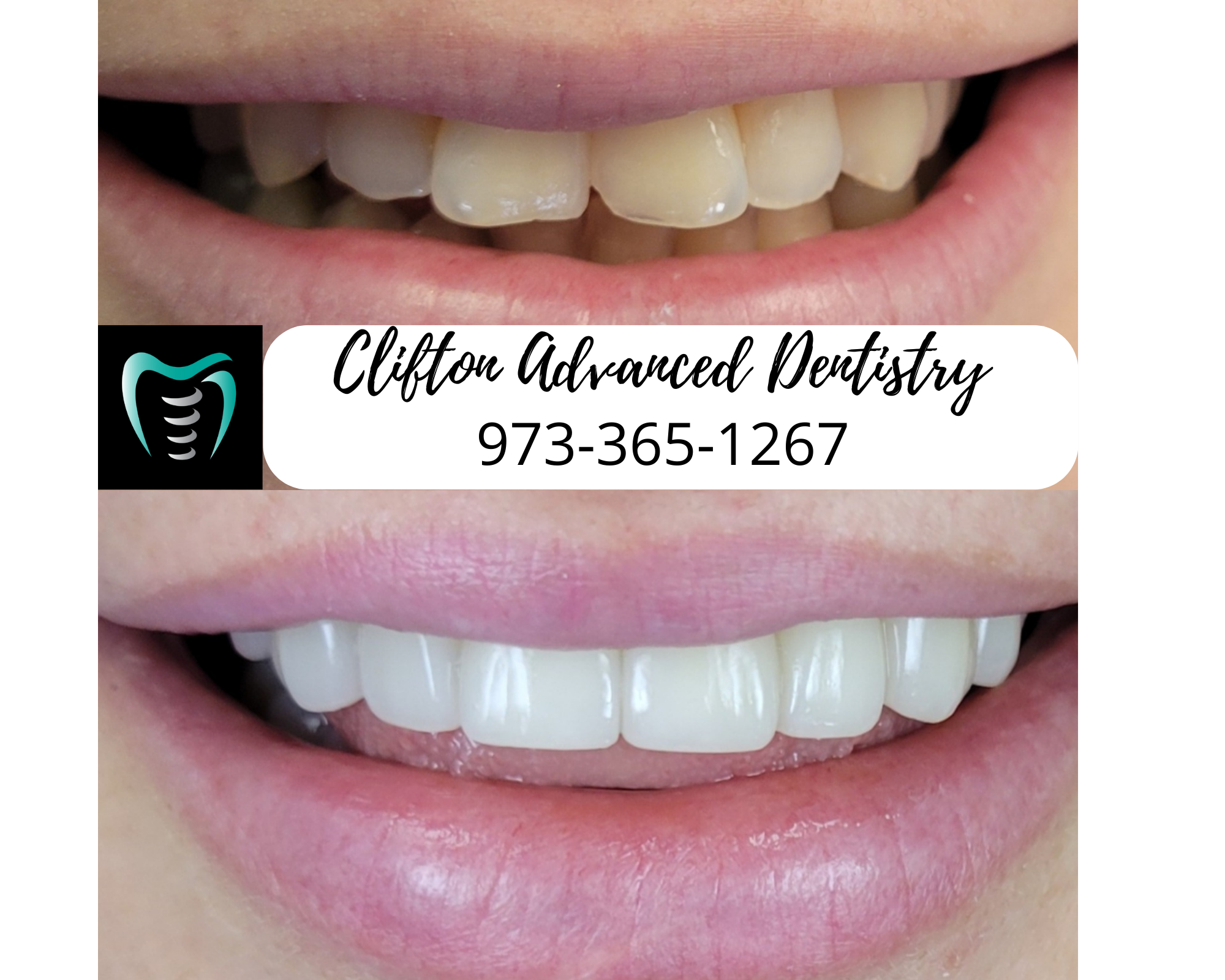 Before and after porcelain veneers treatment