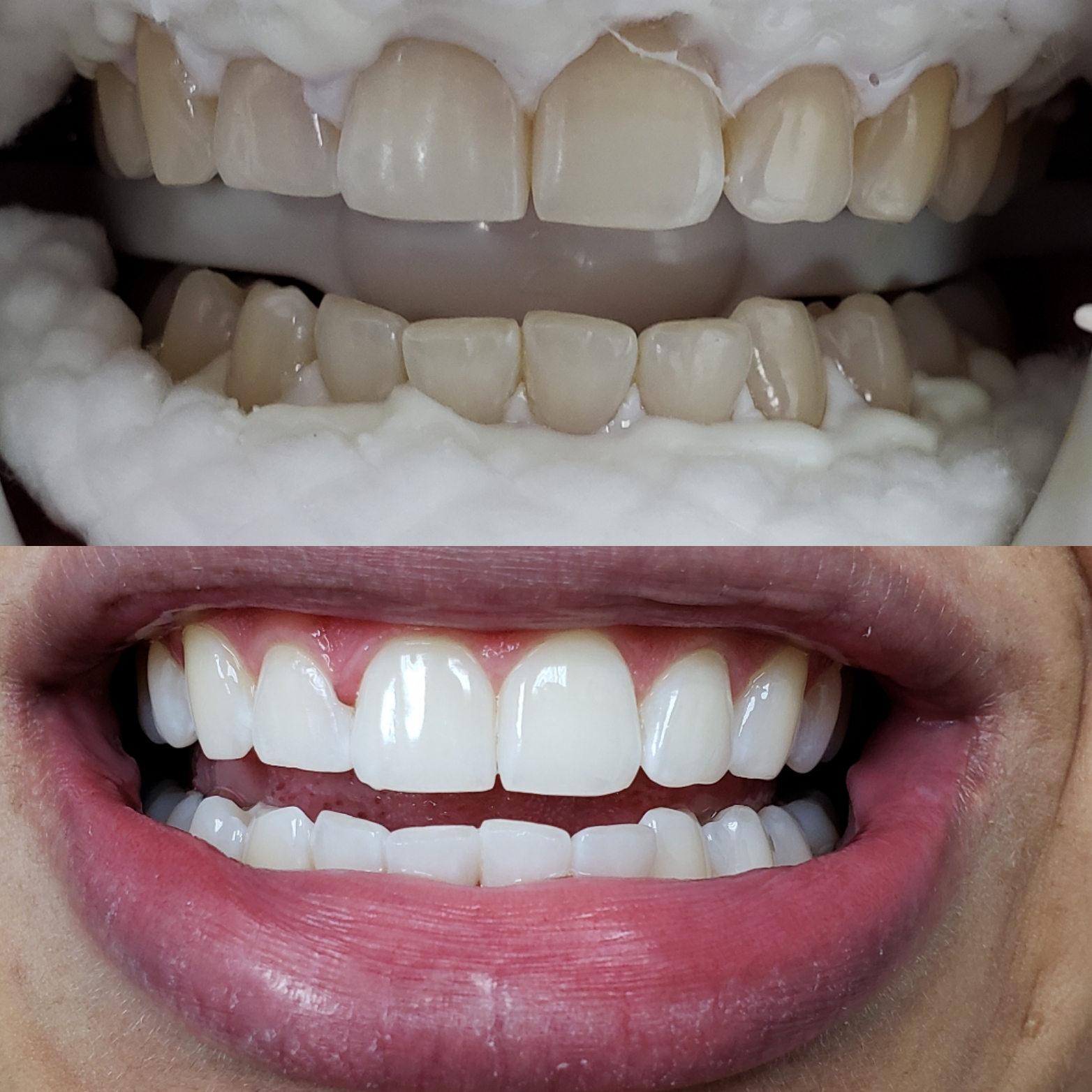 Before and after professional teeth whitening